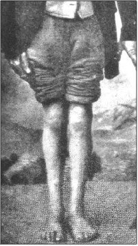 Peter de Rudder nach seiner Heilung 1875