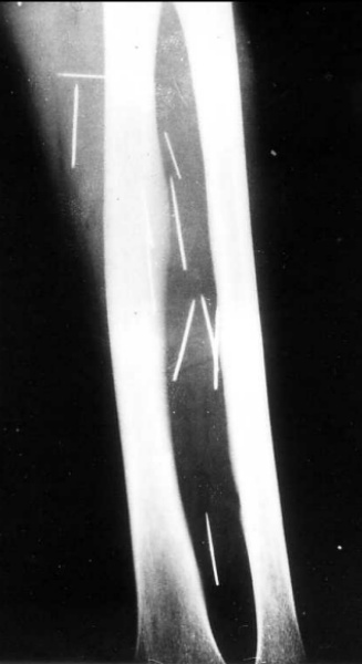 Röntgenaufnahme der Otilia Bertoldi